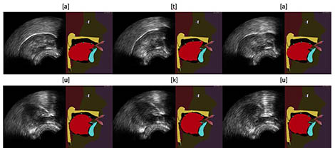 Augmented tongue ultrasound for speech therapy
