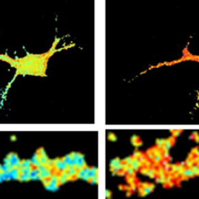 Alzheimer's disease : how amyloid aggregates alter neuronal function