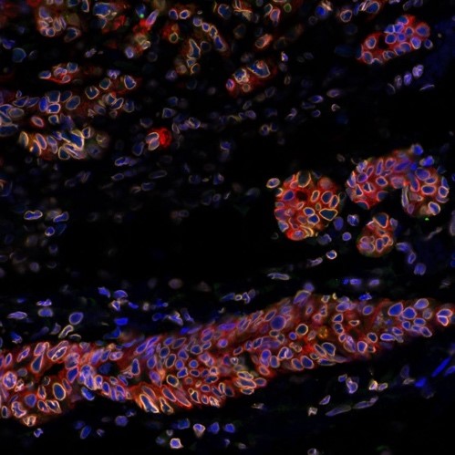 乳がん再発の鍵となる細胞抵抗メカニズムを発見(Relapses of Breast Cancer: Discovery of a Key Cellular Resistance Mechanism)