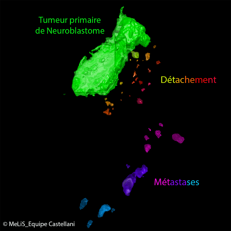 Image montrant le détachement de cellules tumorales primaires pour former des métastases