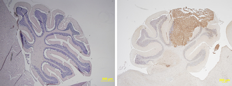 Coupe de cervelet normal (à gauche) et envahi par un médulloblastome (à droite). Le médulloblastome exprime des gènes normalement uniquement actifs dans la rétine, dont NRL et CRX, qui jouent un rôle dans la formation de la tumeur.